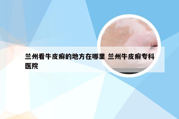 兰州看牛皮癣的地方在哪里 兰州牛皮癣专科医院