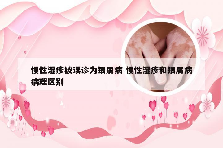 慢性湿疹被误诊为银屑病 慢性湿疹和银屑病病理区别