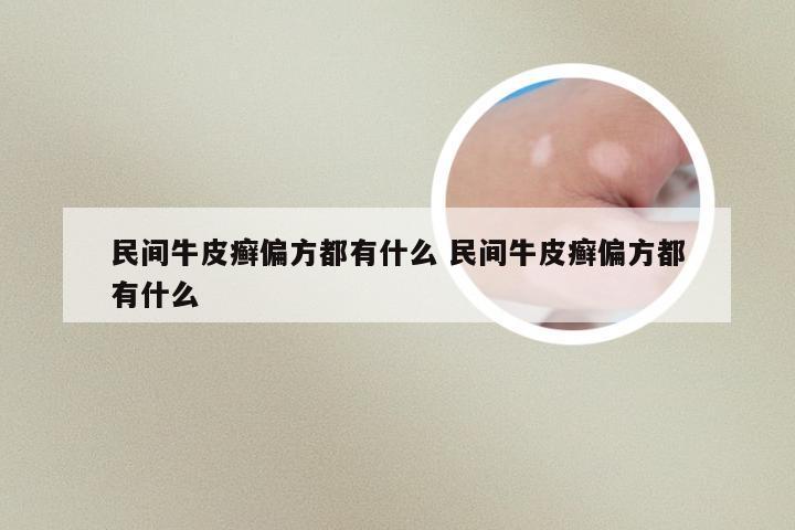 民间牛皮癣偏方都有什么 民间牛皮癣偏方都有什么