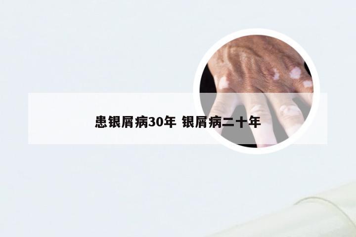 患银屑病30年 银屑病二十年