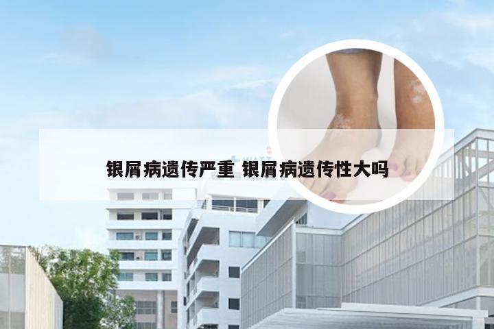 银屑病遗传严重 银屑病遗传性大吗
