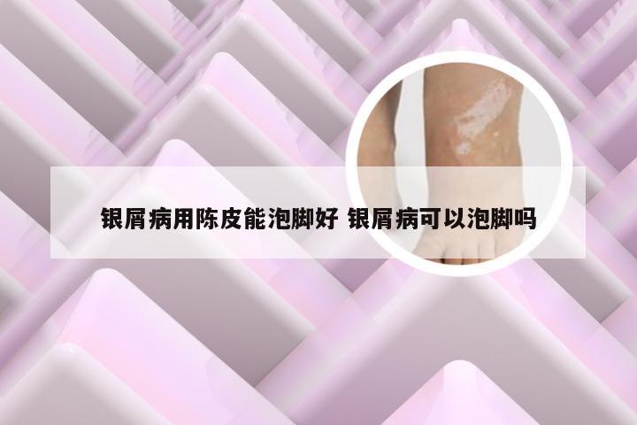 银屑病用陈皮能泡脚好 银屑病可以泡脚吗
