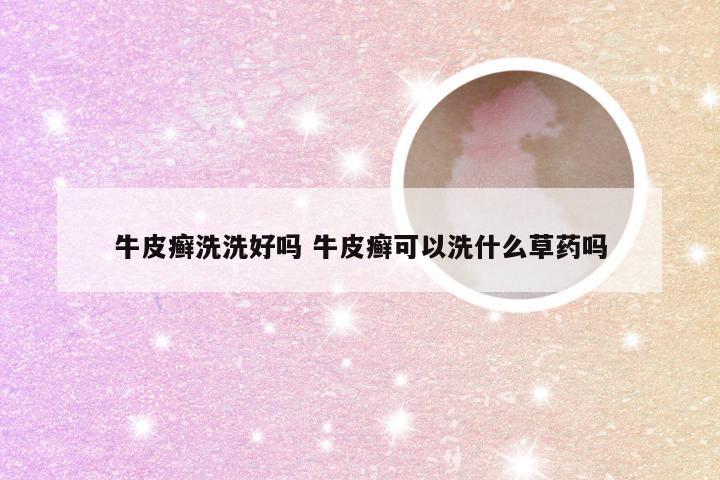牛皮癣洗洗好吗 牛皮癣可以洗什么草药吗