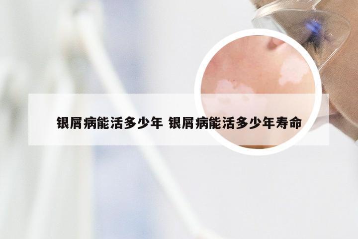 银屑病能活多少年 银屑病能活多少年寿命