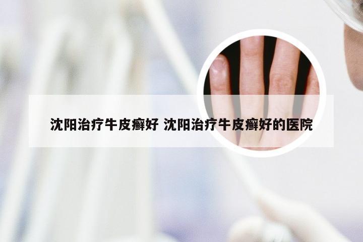 沈阳治疗牛皮癣好 沈阳治疗牛皮癣好的医院