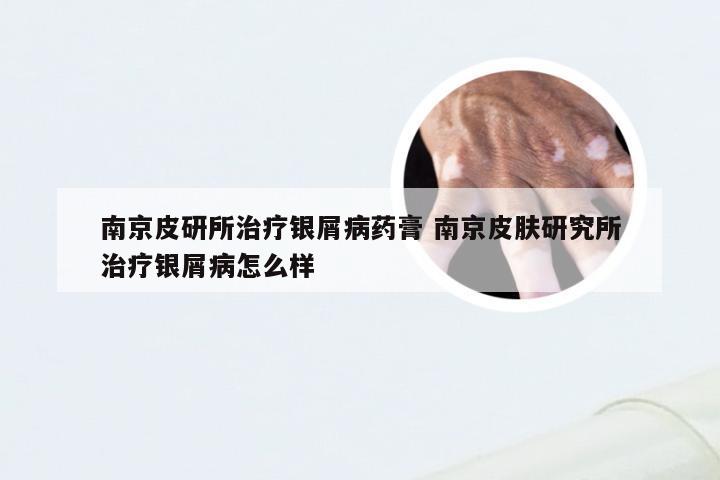 南京皮研所治疗银屑病药膏 南京皮肤研究所治疗银屑病怎么样