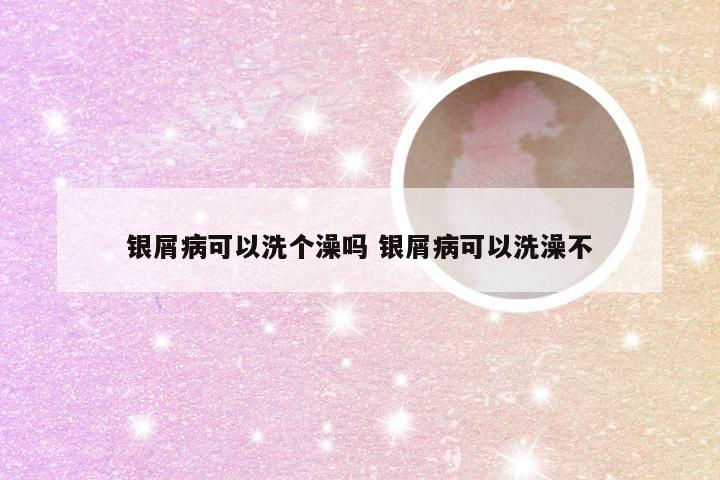 银屑病可以洗个澡吗 银屑病可以洗澡不
