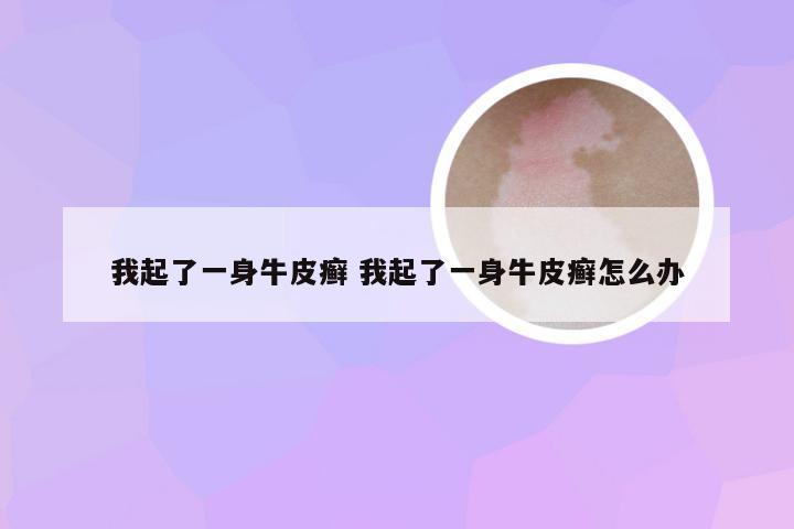 我起了一身牛皮癣 我起了一身牛皮癣怎么办