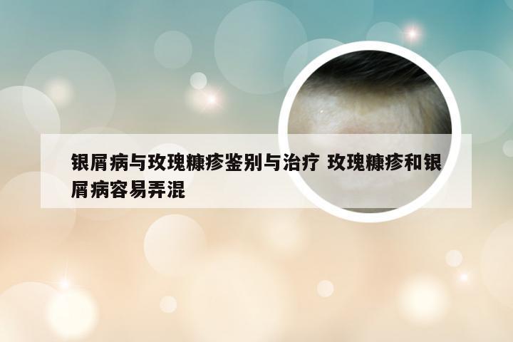 银屑病与玫瑰糠疹鉴别与治疗 玫瑰糠疹和银屑病容易弄混