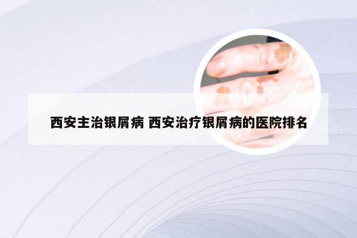 西安主治银屑病 西安治疗银屑病的医院排名