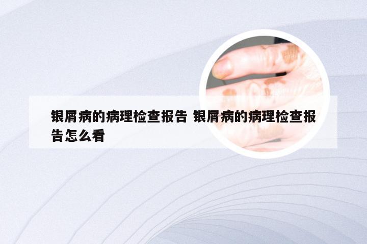 银屑病的病理检查报告 银屑病的病理检查报告怎么看