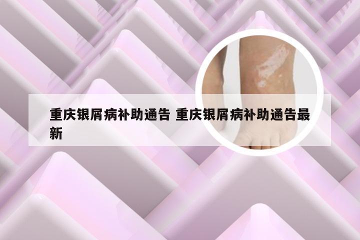 重庆银屑病补助通告 重庆银屑病补助通告最新