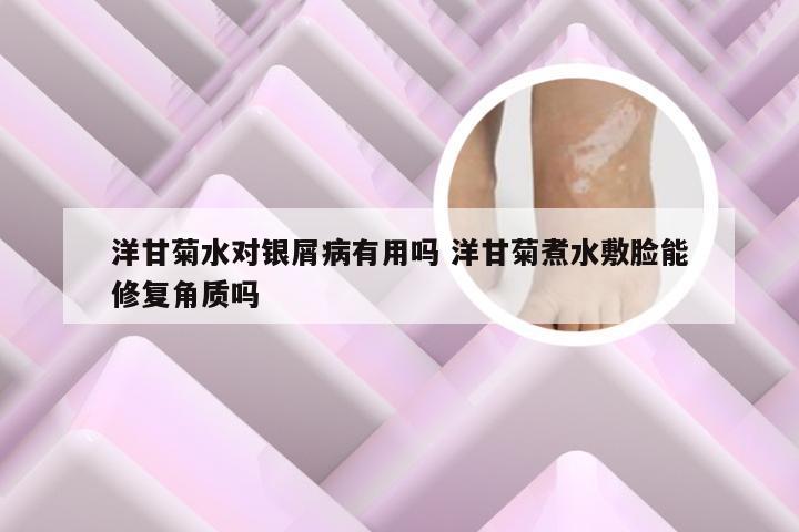 洋甘菊水对银屑病有用吗 洋甘菊煮水敷脸能修复角质吗