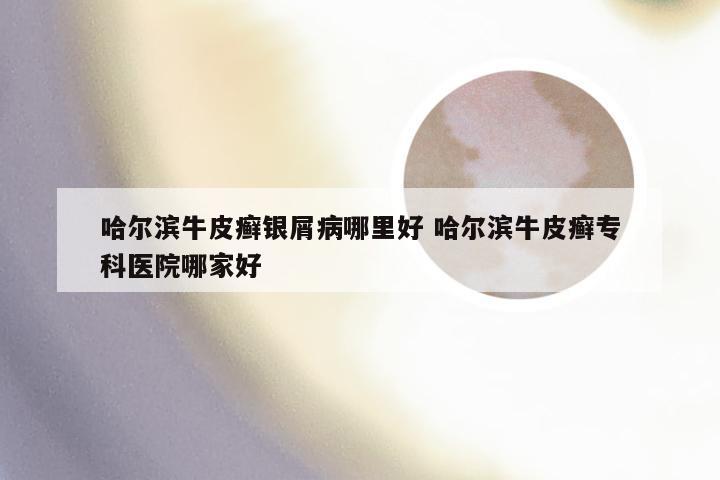 哈尔滨牛皮癣银屑病哪里好 哈尔滨牛皮癣专科医院哪家好