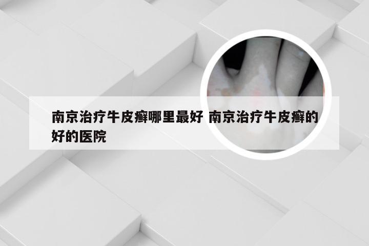 南京治疗牛皮癣哪里最好 南京治疗牛皮癣的好的医院