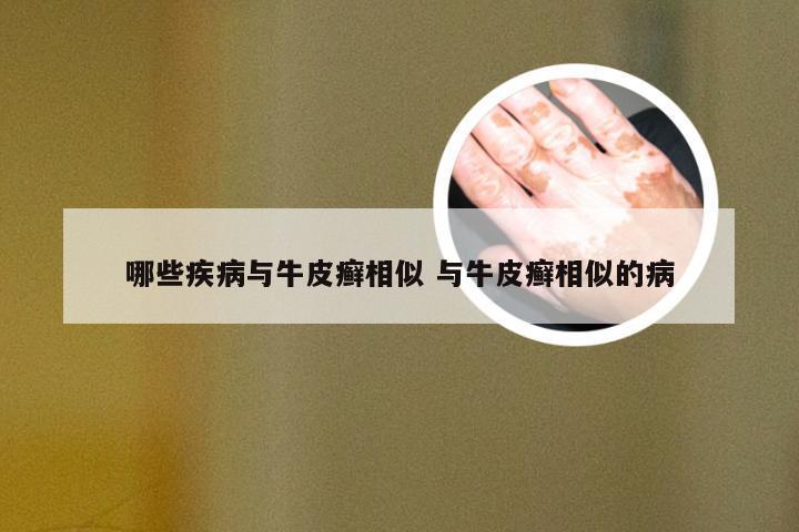 哪些疾病与牛皮癣相似 与牛皮癣相似的病