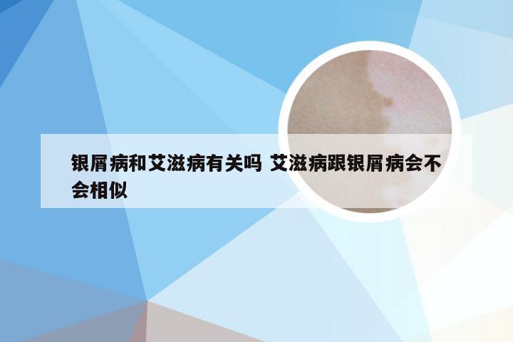 银屑病和艾滋病有关吗 艾滋病跟银屑病会不会相似