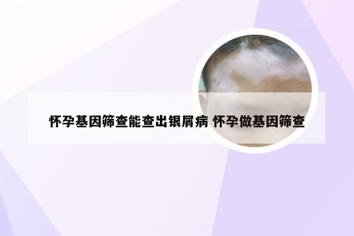 怀孕基因筛查能查出银屑病 怀孕做基因筛查