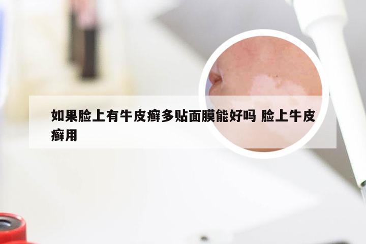 如果脸上有牛皮癣多贴面膜能好吗 脸上牛皮癣用