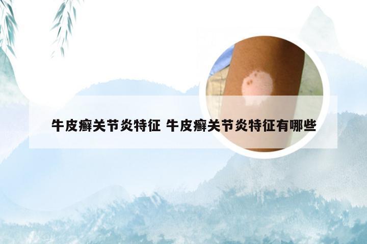 牛皮癣关节炎特征 牛皮癣关节炎特征有哪些