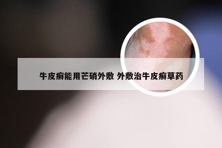 牛皮癣能用芒硝外敷 外敷治牛皮癣草药