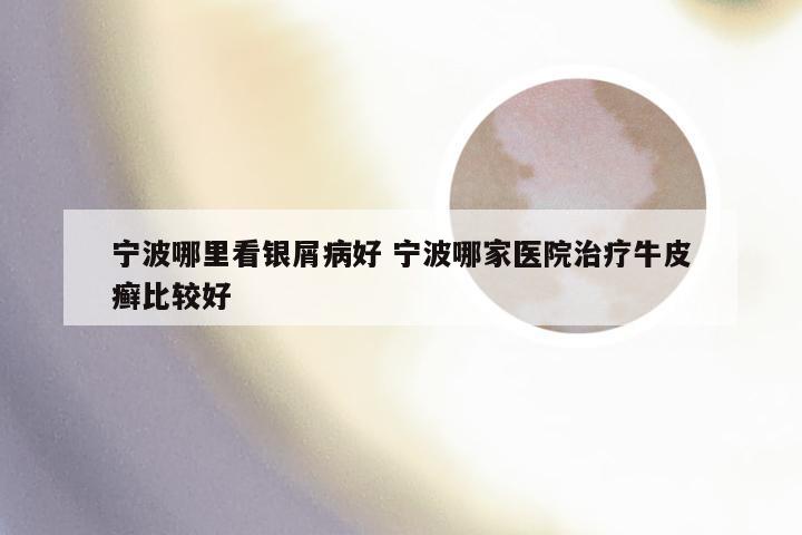 宁波哪里看银屑病好 宁波哪家医院治疗牛皮癣比较好