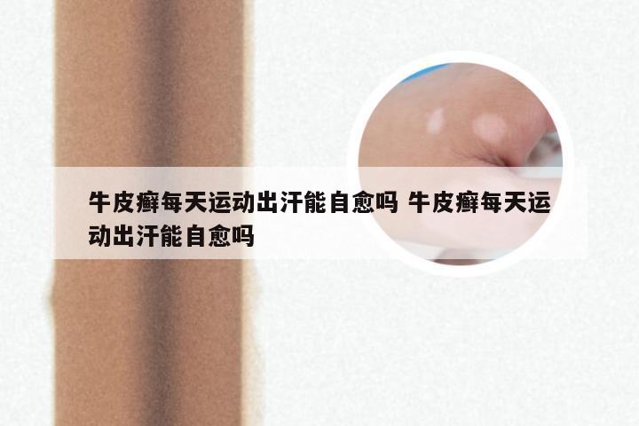 牛皮癣每天运动出汗能自愈吗 牛皮癣每天运动出汗能自愈吗