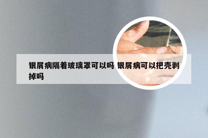 银屑病隔着玻璃罩可以吗 银屑病可以把壳剥掉吗