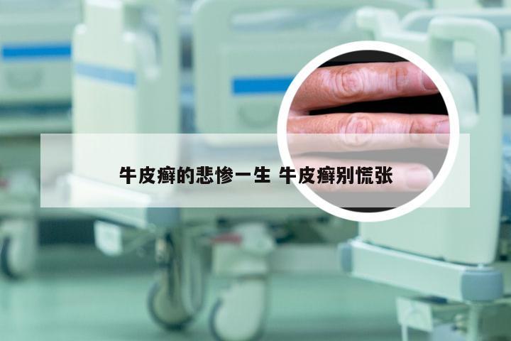 牛皮癣的悲惨一生 牛皮癣别慌张