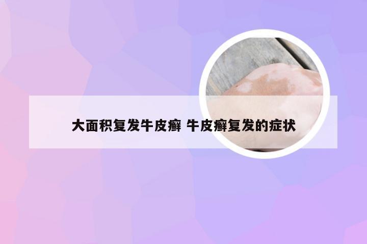 大面积复发牛皮癣 牛皮癣复发的症状