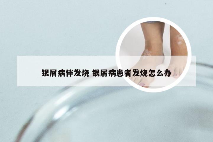 银屑病伴发烧 银屑病患者发烧怎么办