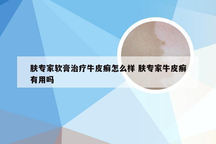 肤专家软膏治疗牛皮癣怎么样 肤专家牛皮癣有用吗
