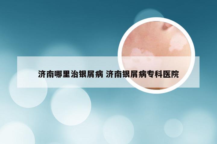 济南哪里治银屑病 济南银屑病专科医院