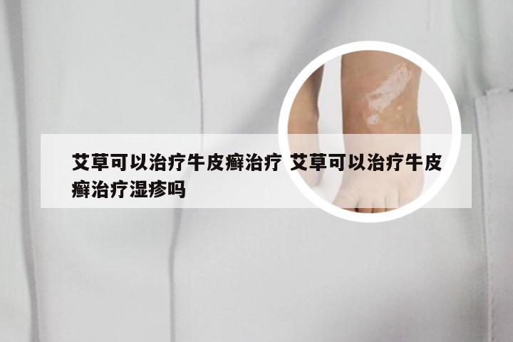 艾草可以治疗牛皮癣治疗 艾草可以治疗牛皮癣治疗湿疹吗