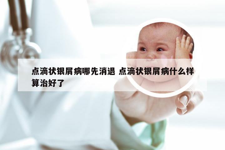 点滴状银屑病哪先消退 点滴状银屑病什么样算治好了