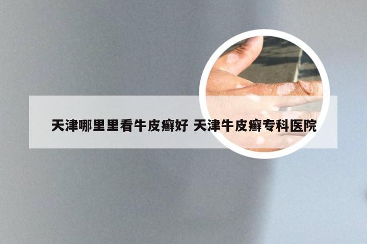 天津哪里里看牛皮癣好 天津牛皮癣专科医院