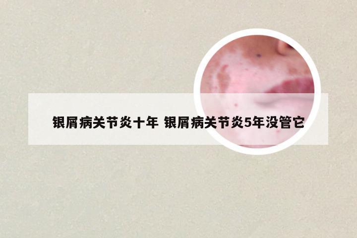 银屑病关节炎十年 银屑病关节炎5年没管它