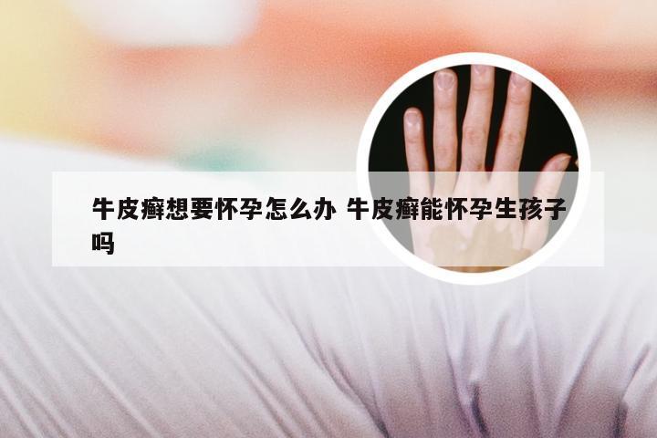 牛皮癣想要怀孕怎么办 牛皮癣能怀孕生孩子吗