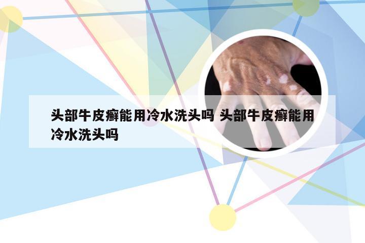 头部牛皮癣能用冷水洗头吗 头部牛皮癣能用冷水洗头吗