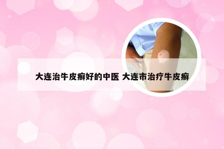 大连治牛皮癣好的中医 大连市治疗牛皮癣