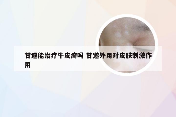 甘遂能治疗牛皮癣吗 甘遂外用对皮肤刺激作用