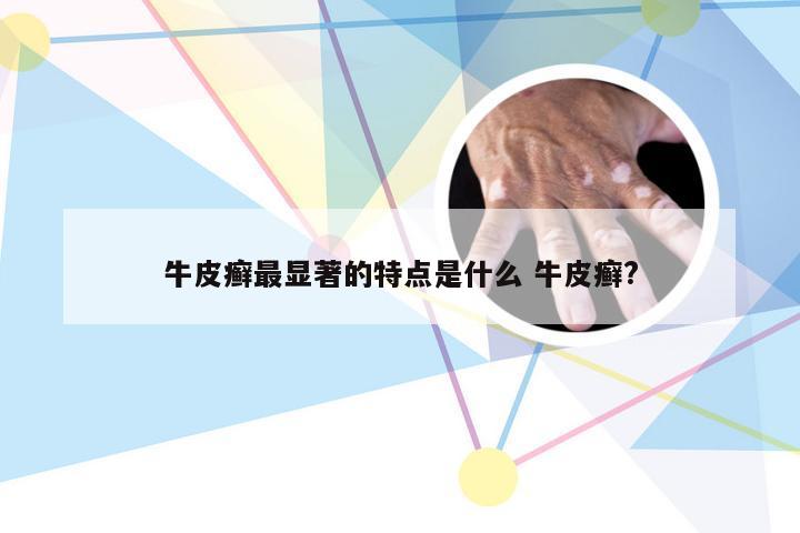 牛皮癣最显著的特点是什么 牛皮癣?