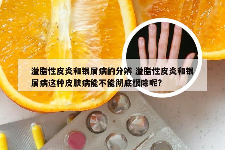 溢脂性皮炎和银屑病的分辨 溢脂性皮炎和银屑病这种皮肤病能不能彻底根除呢?