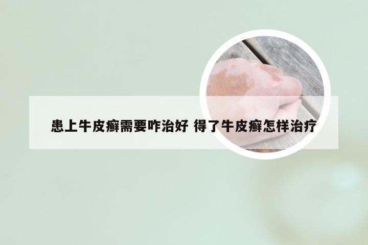 患上牛皮癣需要咋治好 得了牛皮癣怎样治疗