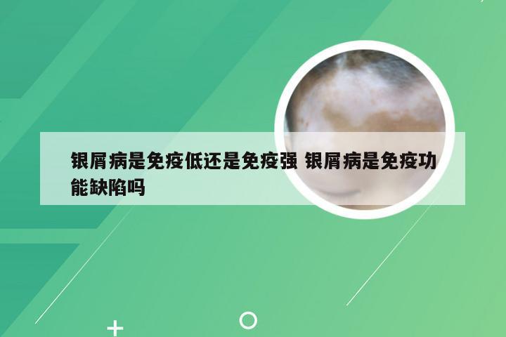 银屑病是免疫低还是免疫强 银屑病是免疫功能缺陷吗
