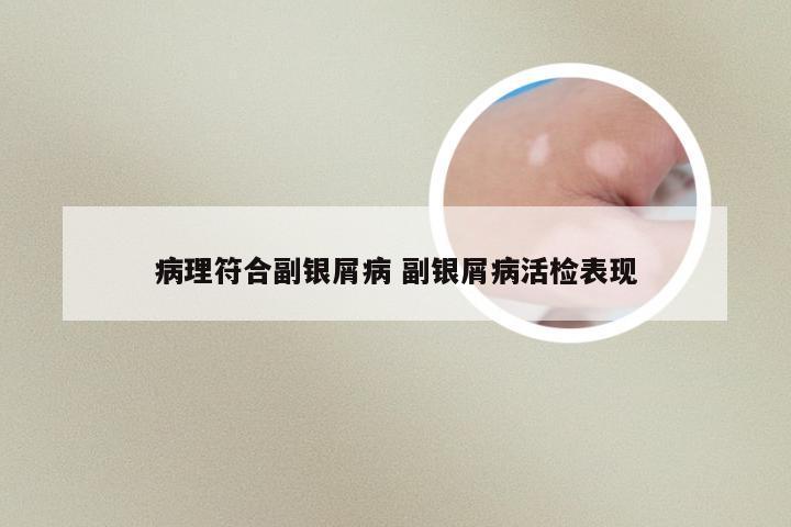 病理符合副银屑病 副银屑病活检表现