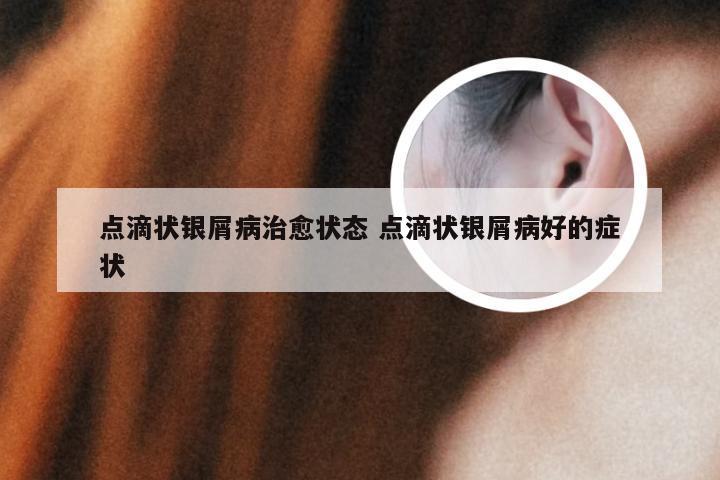 点滴状银屑病治愈状态 点滴状银屑病好的症状