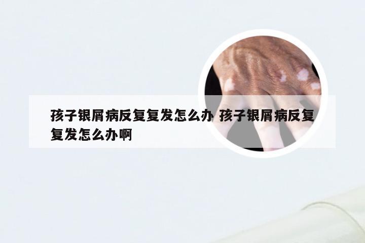 孩子银屑病反复复发怎么办 孩子银屑病反复复发怎么办啊