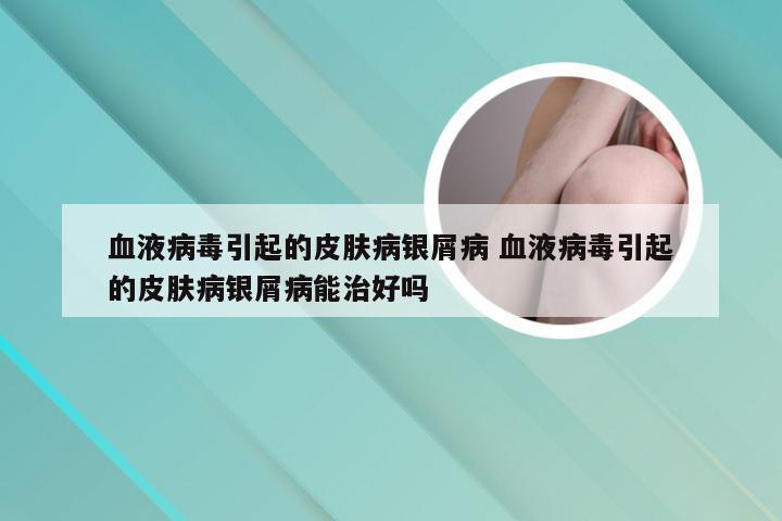 血液病毒引起的皮肤病银屑病 血液病毒引起的皮肤病银屑病能治好吗