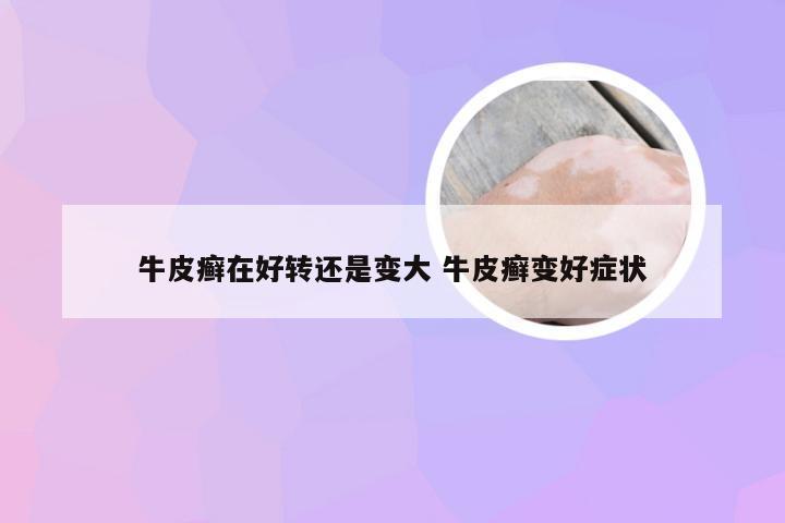 牛皮癣在好转还是变大 牛皮癣变好症状